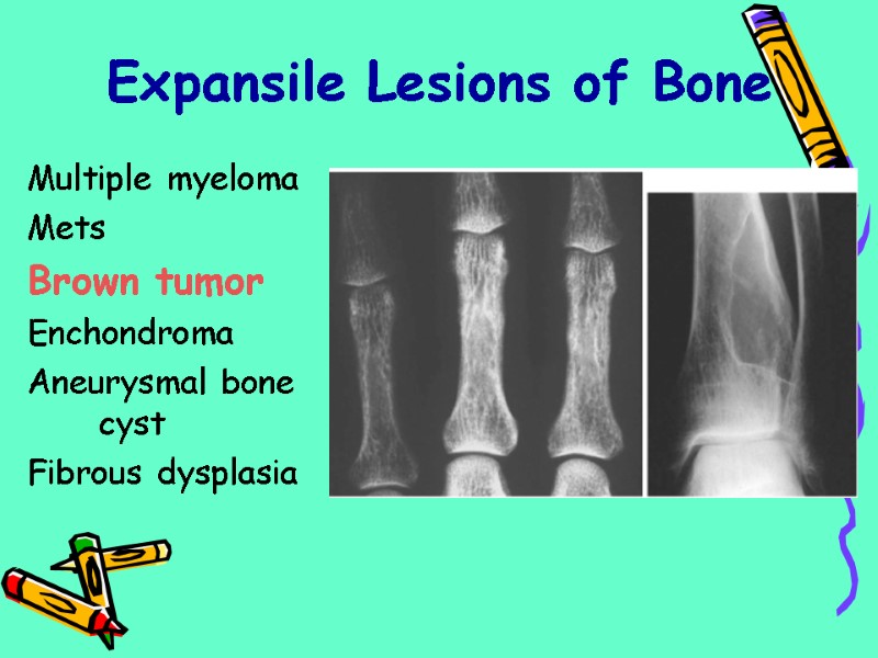 Multiple myeloma  Mets Brown tumor Enchondroma Aneurysmal bone cyst Fibrous dysplasia  Expansile